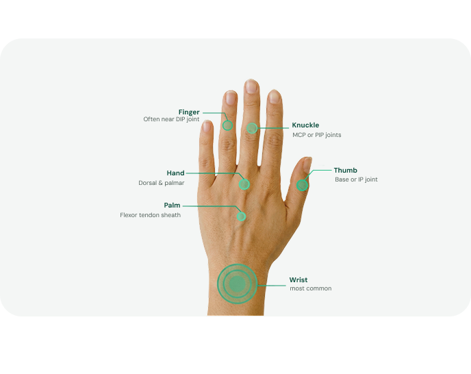 ganglion-cyst-removal-common-location
